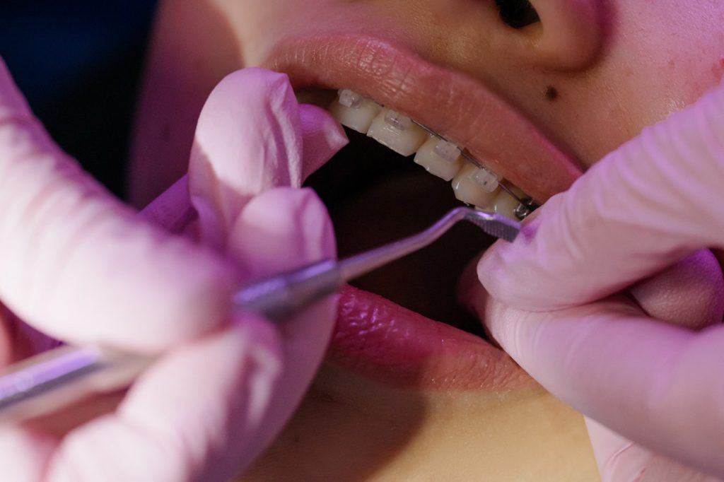 woman getting braces