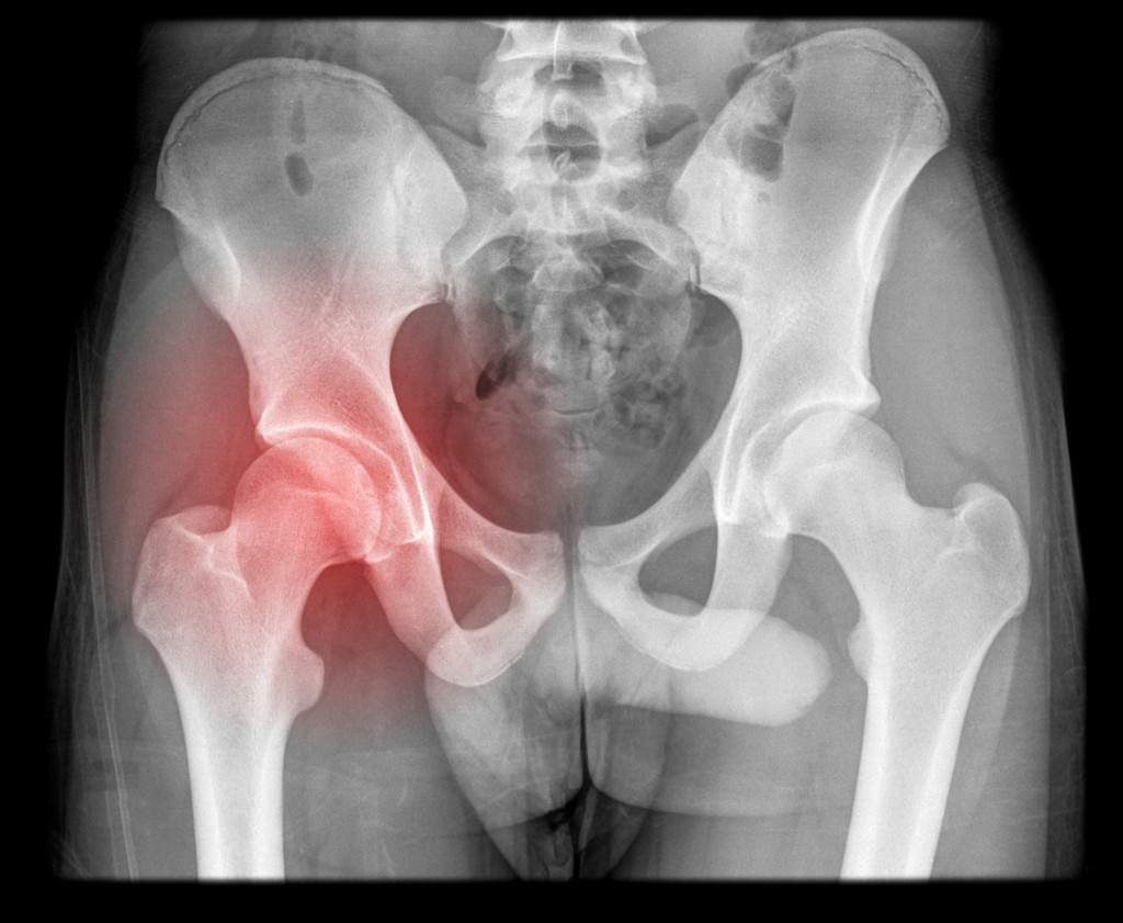 pelvic bones x-ray with red accent on the left side